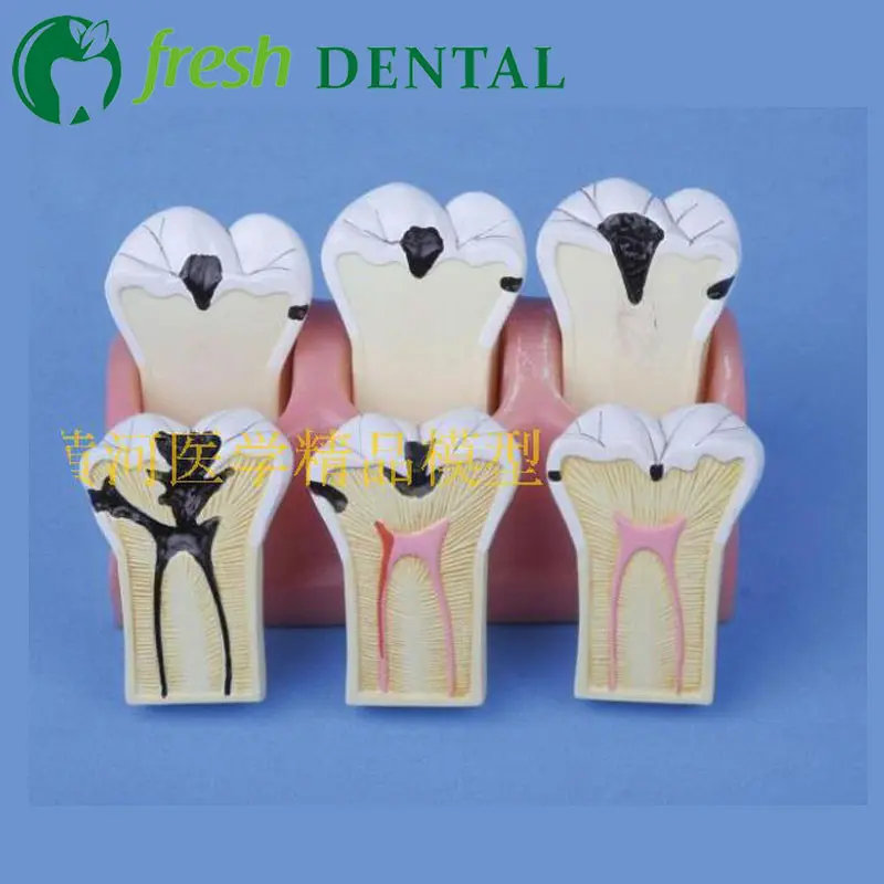 

1pc Dental Caries Decomposition Model Tooth Model Dental Teaching Model Molar Teeth Model Free Shipping SL718