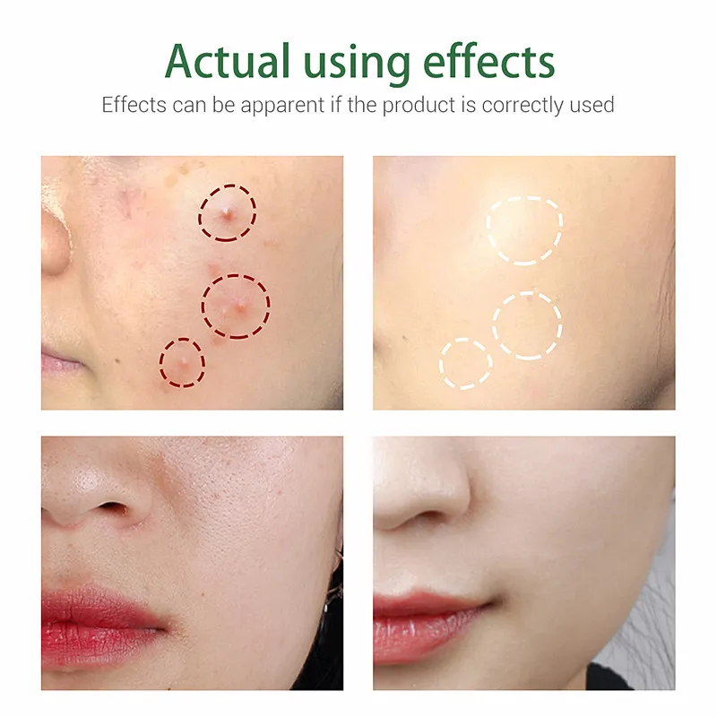 

Tea Tree Anti-acne Cleanser