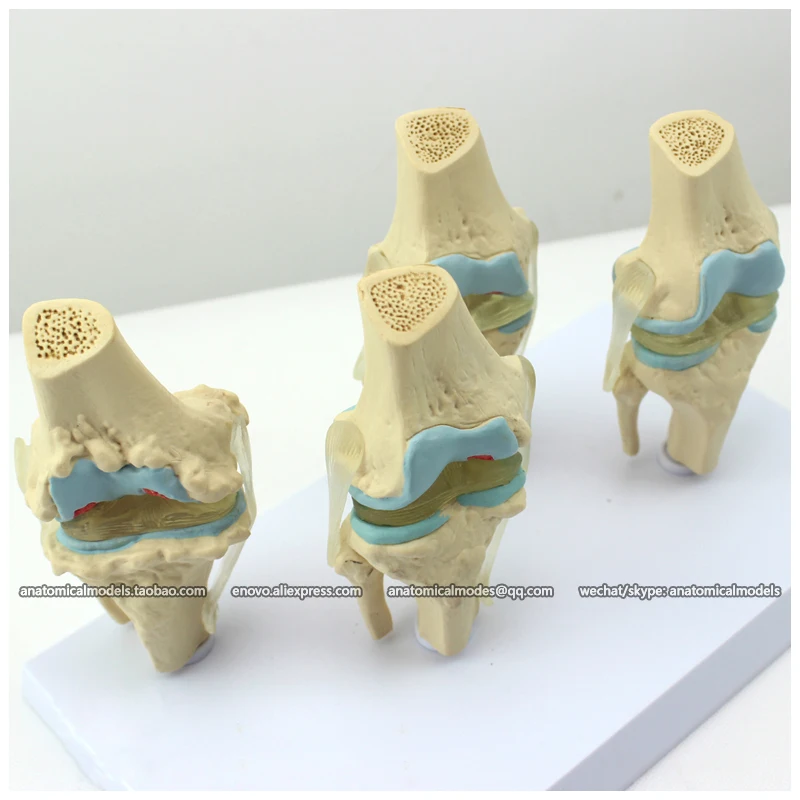 12359/человека 4-х ступенчатый остеоартрит колена комплект совместное Исследование