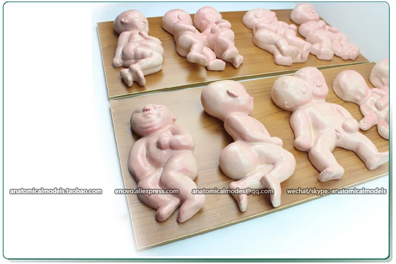 CMAM/12452 патологическая модель плода мочеполового и медицинского обучения