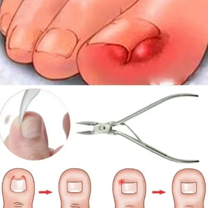 Ingrown Toenails Pedicure Foot Care Tool Nail Correction Clipper Cutters For Orthotic Acronyx Dead Skin Remover Podiatry
