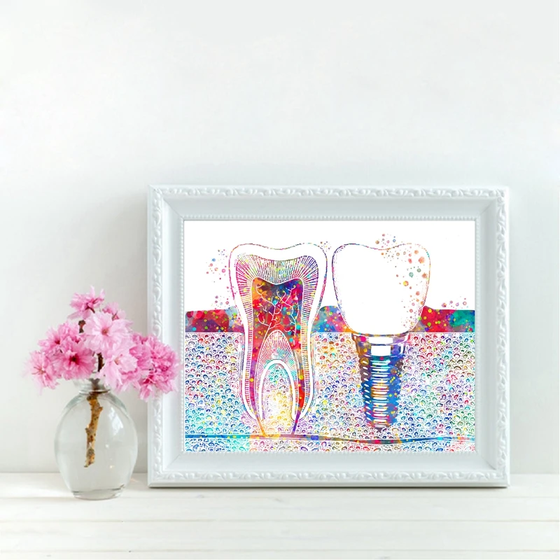 Зубной имплантат печать подарок для дантиста стоматологическая клиника Настенный декор гигиенист офис искусство медицина Холст Картина зуб акварельный плакат