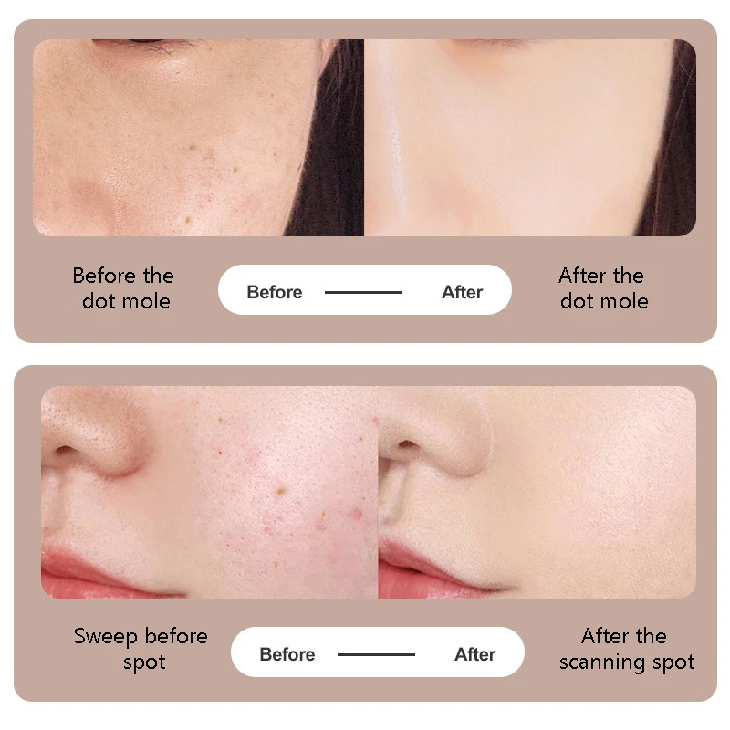 Лазерная плазменная ручка прибор для удаления веснушек родинок татуировок