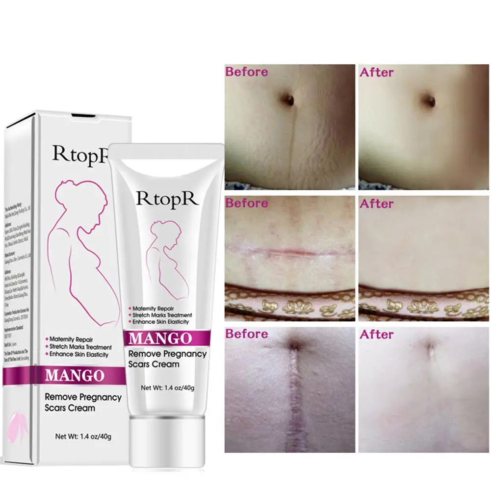 

Крем от акне и растяжек, 40 г