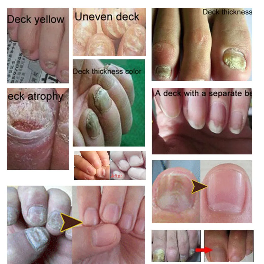 1 шт. эссенция для удаления грибка ногтей|Средства ухода за ногтями| |
