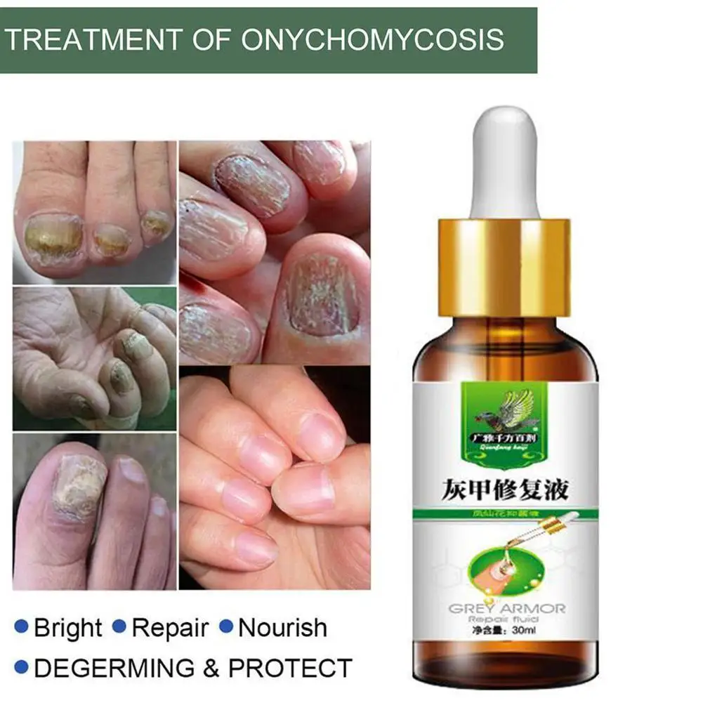 

Травяное Лечение ногтей от грибков эфирное масло удаление ногтевой инфекции уход за паронихией противоинфекционный грибок онихомикоз S9B1