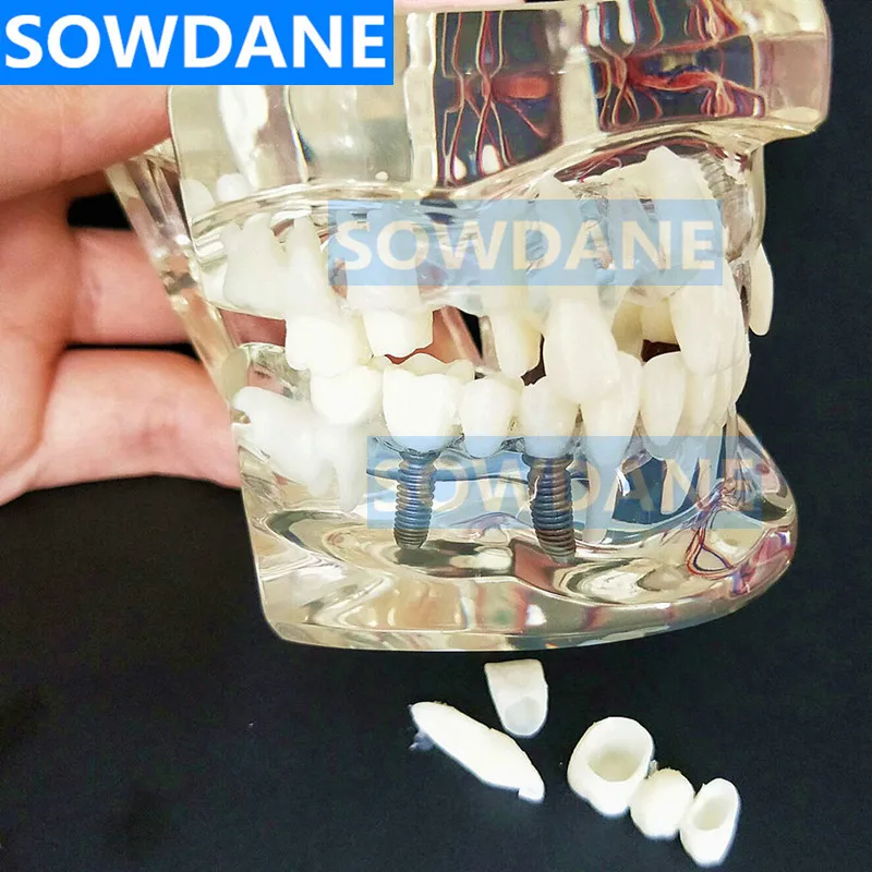Модель зубного имплантата с мостиком для восстановления зубов стоматолог