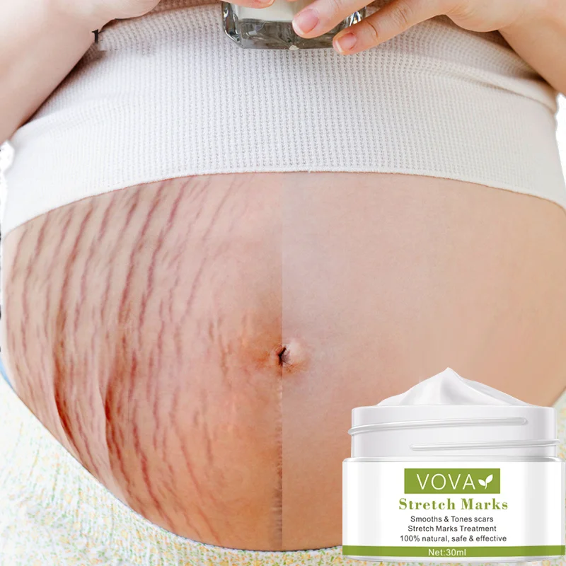 

Effective Removal Stretch Mark Cream Postpartum Obesity Pregnant Women Scar Repair Anti-Aging Anti-Winkles Moisturizer Body Care