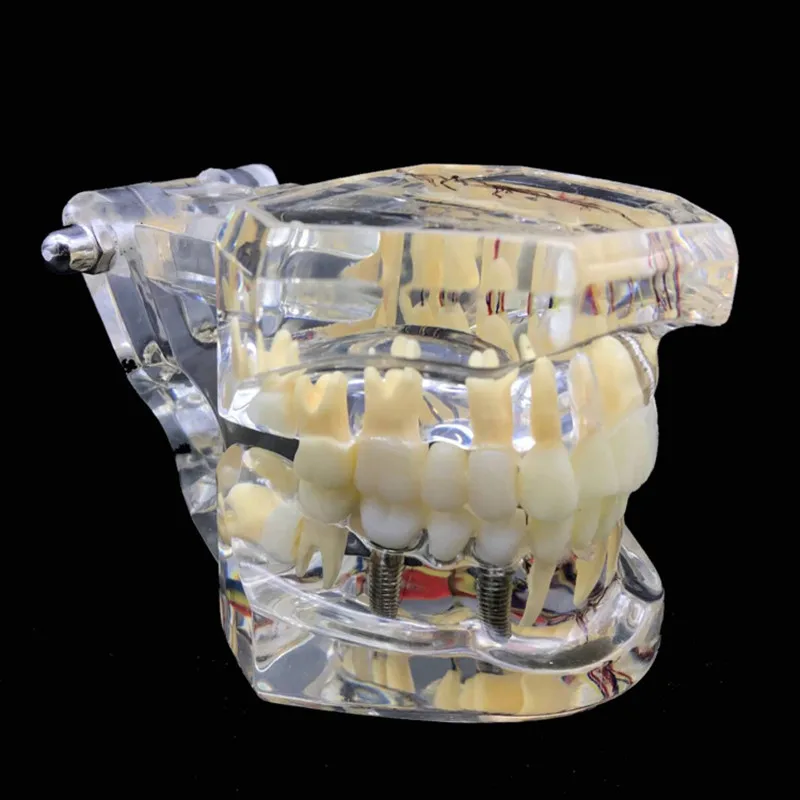 Стоматологическая реставрация зубов Модель с зубным нервом отсоединяемые зубы