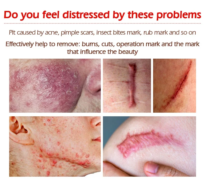 

2021 Acne Scar Removal Cream Pimples Stretch Marks Face Gel Remove Acne Smoothing Whitening Moisturizing Body Skin Care Aichun