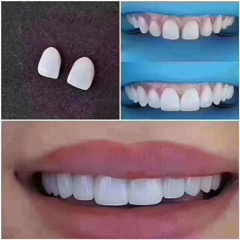 

3Pcs No.23# Dental Veneers Whitening Ceramic Bright White LMS