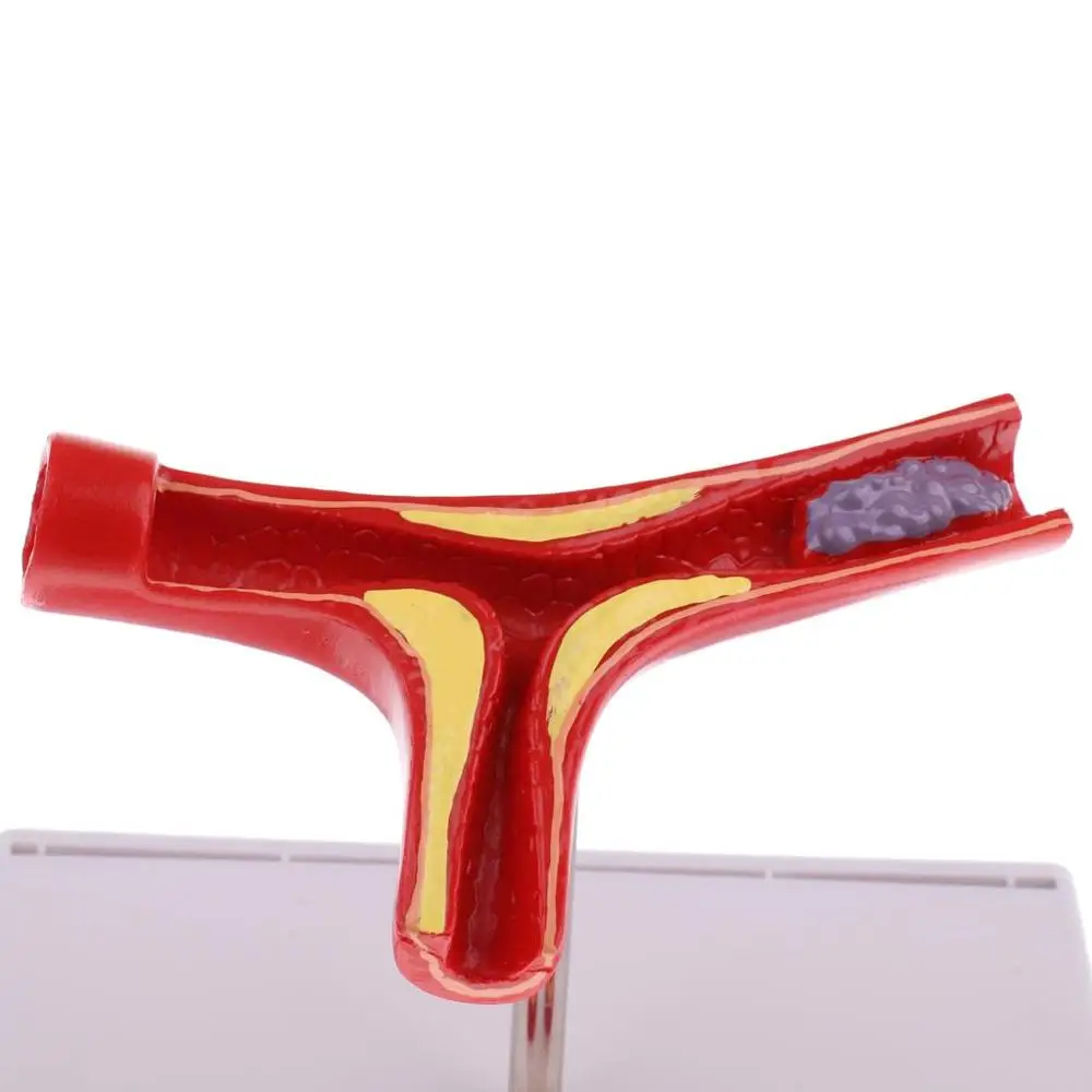 Лабораторные принадлежности 50 раз увеличенный человеческий сосуд атеросклероза