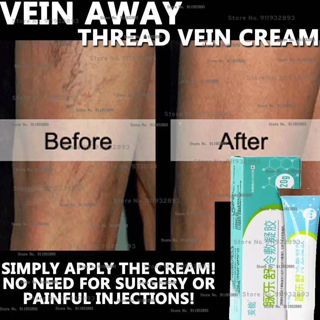 

Vein Removal CREAM LOTION ANTI VARICOSE SPIDER THREAD VEIN 100% NATURAL HERBAL