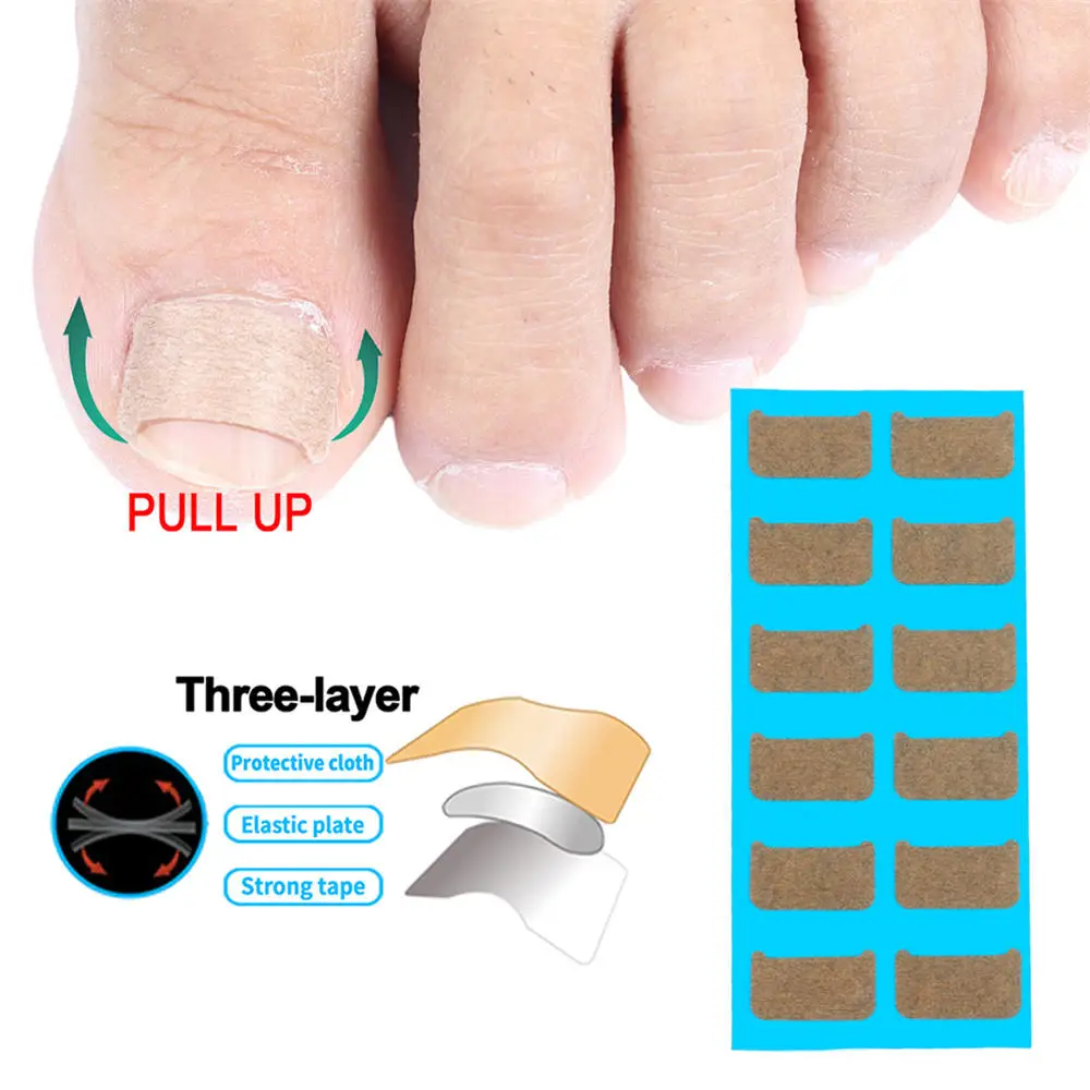 

36pcs Ingrown Toenail Correction Stickers Nail Corrector Patches Paronychia Treatment Recover Sticker Pedicure Foot Care Tools