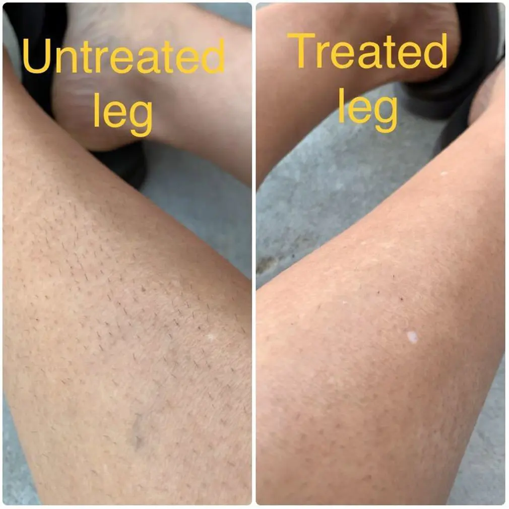 Лазерный эпилятор безболезненное устройство для перманентного удаления волос