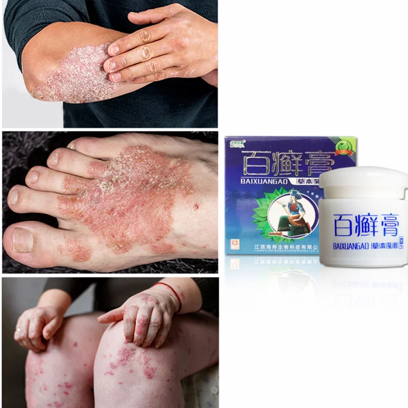 

18g Ointment Herbal Treatment for Skin Itching Antibacterial Tinea Pedis Psoriasis Eczema Cream Fungal Infection Local Body Care