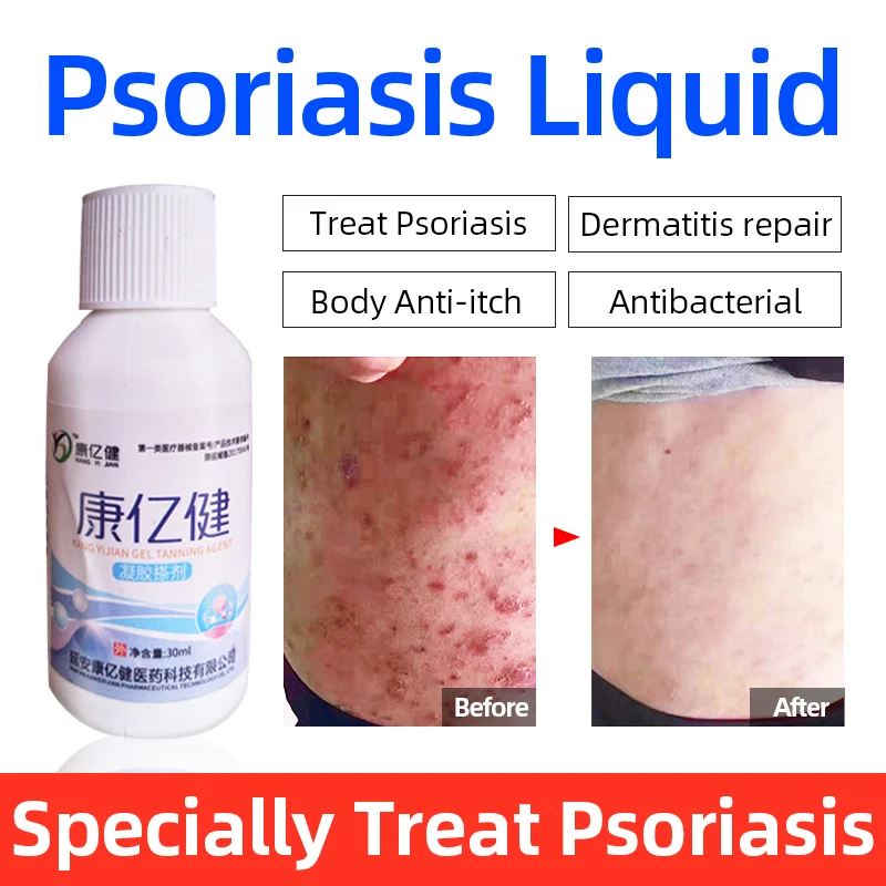 

Natural Herbal Medicine Psoriasis Gel Liquid Antibacterial Psoriasis Dermatitis Itching Repair Body Eczema Psoriasis SkinAllergy