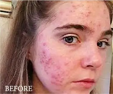 99% алоэ успокаивающий гель алоэ вера гель Уход за кожей удаляет мыло от акне увлажняющее мыло для тела и лица солнцезащитный гель алоэ 85 г