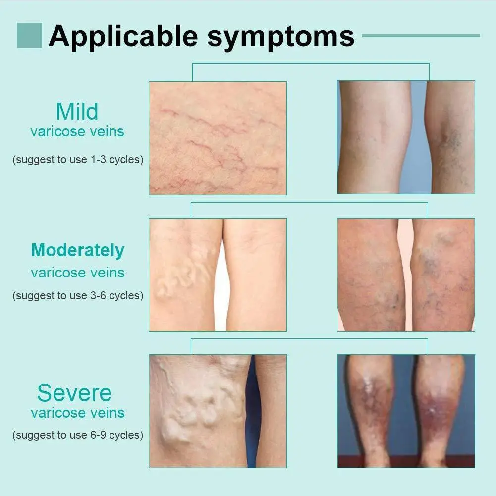 

Varicose Veins Cream Varicosity Angiitis Remedy Ointment Relief Veins Pain Phlebitis Spider Legs Bosy Skin Care