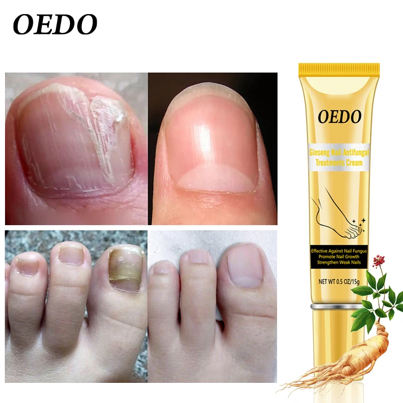 Herbal Fungal Nail Treatment Ginseng Antifungal Treatments Cream Removal Repair Essence Onychomycosis Foot | Красота и здоровье