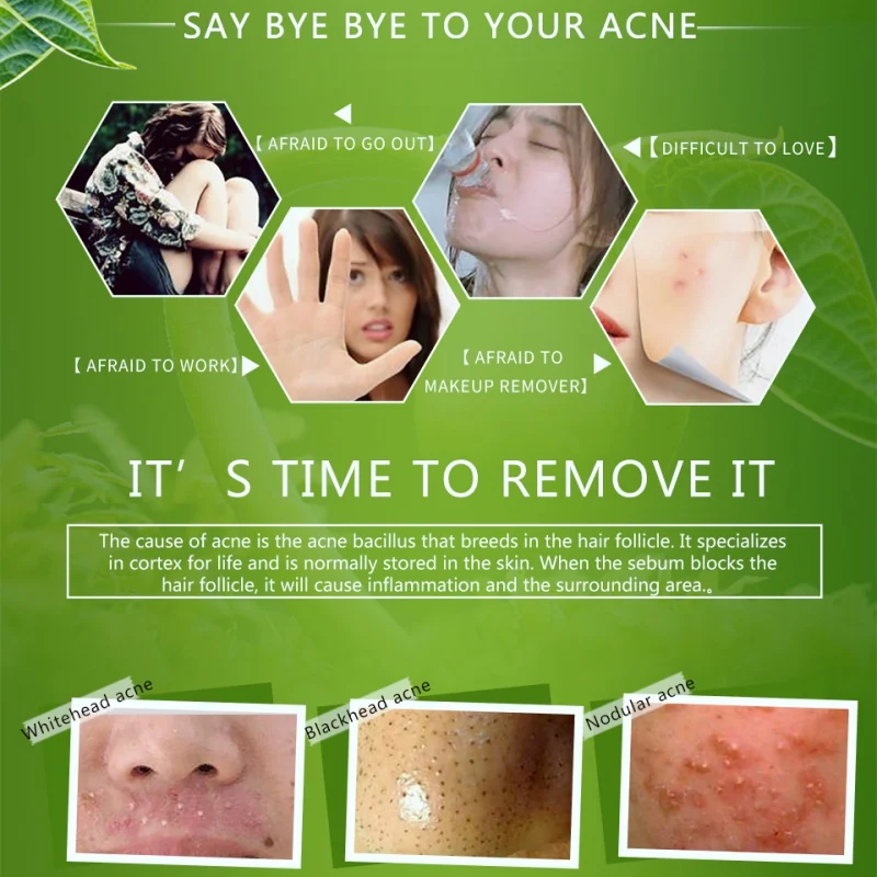 Удаление прыщей угрей увлажняющий отбеливающий контроль масла термоусадочные