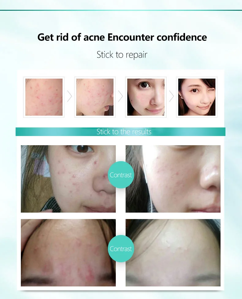 WXE Успокаивающий Крем для восстановления акне Удаление меланина лечение крем