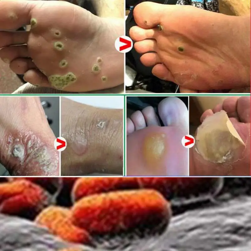 

Skin Tag Remover Genital Wart Treatment Removal Mole & Papillomas Foot Corn Medical Repair Tool Natural Bacteriostatic Liquid