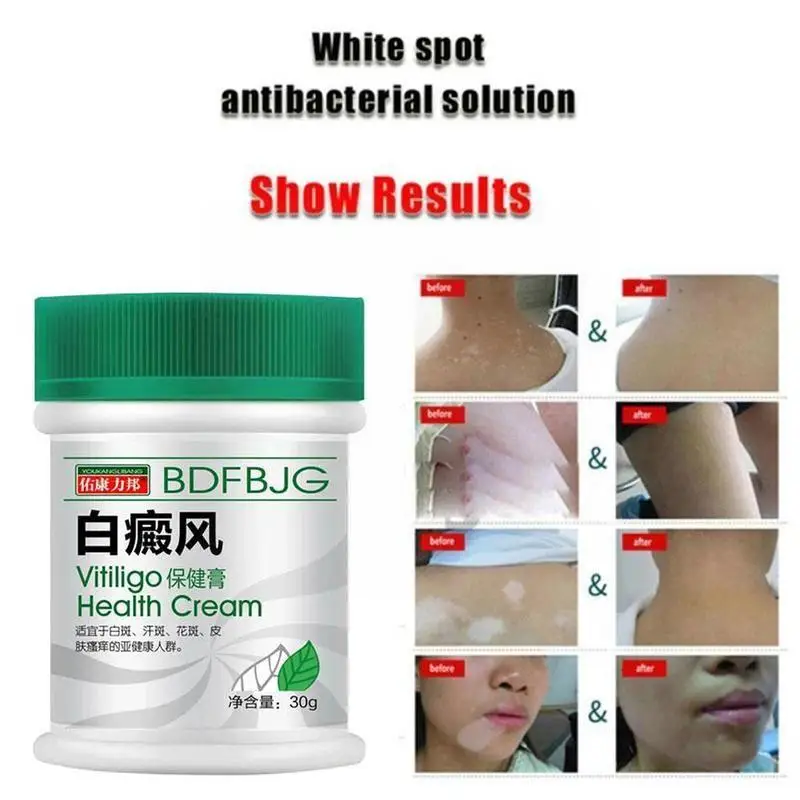Мазь Sumifun китайская для Vitiligo 30 мл | Красота и здоровье