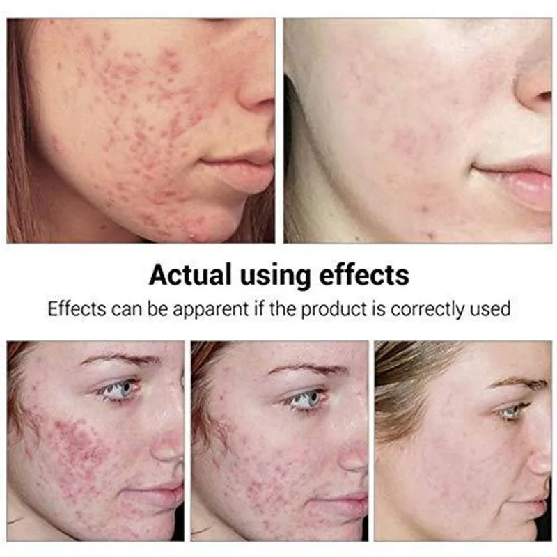 

17ml Tea Tree Acne Treatment Serum Fade Acne Marks Removal Moisturizing Skin Care Reduction Pore Whitening Scar Esse E0W3