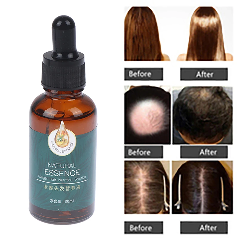 

Ginger Hair Growth Essential Oils Prevent Baldness Hair Loss Hair Serum Repair