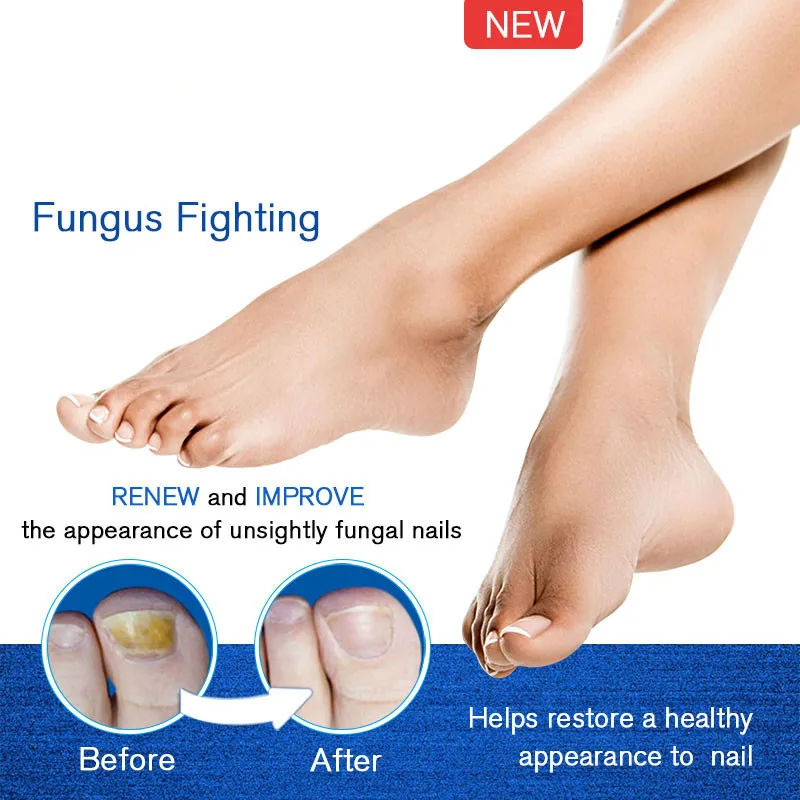 

Powerful Nail Treatment Pen Onychomycosis Paronychia Anti Fungal Nail Infection Chinese Herbal Toe Fungus Care Repair Serum