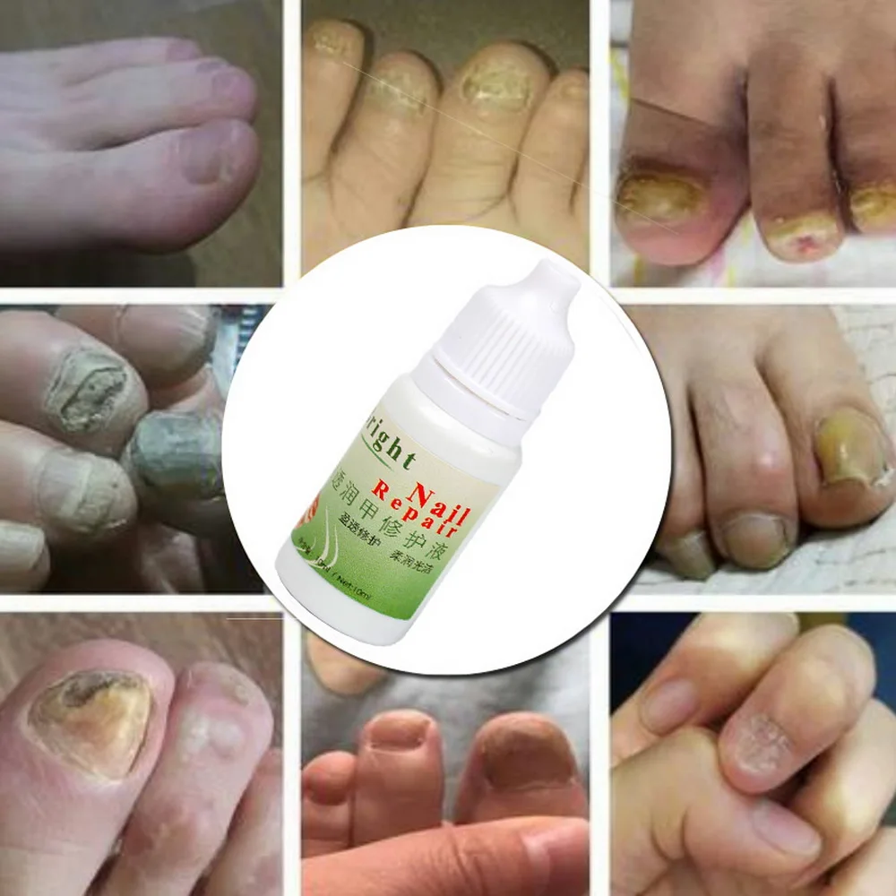 Крем для лечения грибка от паронихии и онихомикоза 100% 10 мл | Красота здоровье