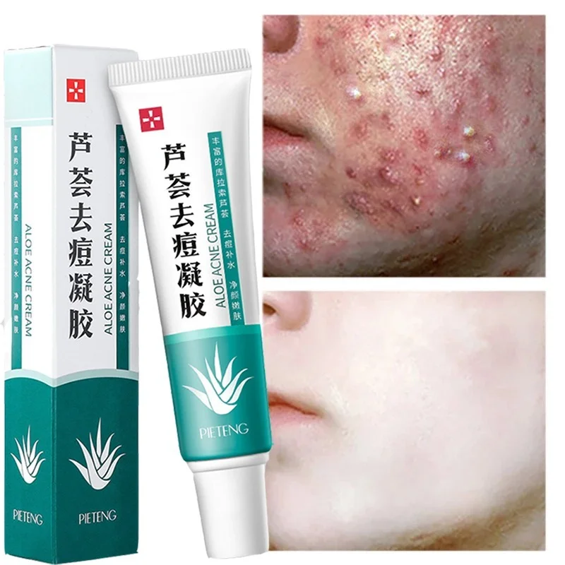 

3pcs Effective Anti-acne Cream Reduce Acne Spots, Oil Control, Shrink Pores, Skin Care, Aloe Vera Gel Acne Facial Aloe Vera Gel