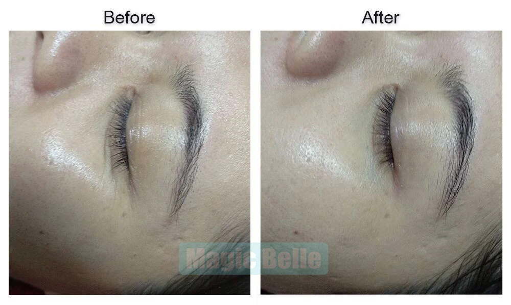 

Refill Gas Cylinder CO2 Cartridges and Hyaluronic Acid Mesotherapy Frozen Skin Gun for Wrinkle Removal Whitening