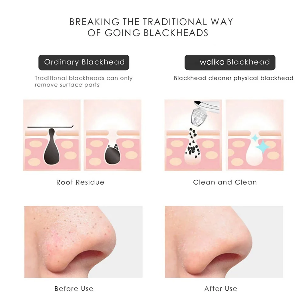 Вакуумный инструмент для удаления черных точек на лице с 4 головками|Устройство