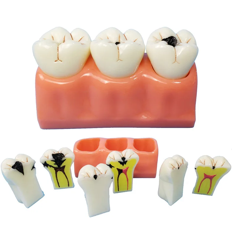 

Dental Caries Disassembling Model 4 Times Denture Disease Teeth Model Dentist Tooth Decay Model for Teaching Decomposition Model