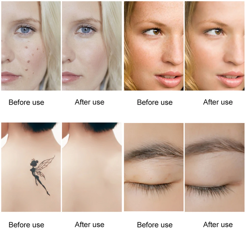 Лазерная пикосекундная ручка LESCOLTON средство для удаления татуировок светильник