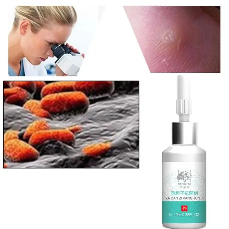 10 мл Антибактериальный раствор 0f для рук и ног тела Кукурузные коконы бородавки