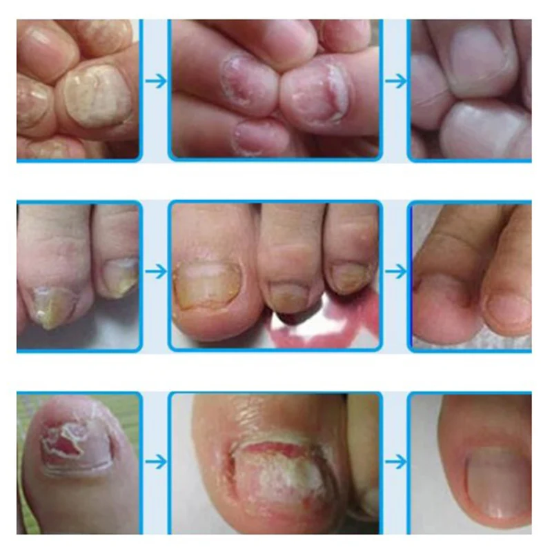 

3 Days Effect Fungus Removal Essence Liquid Fungal Nail Treatment Bright Nail