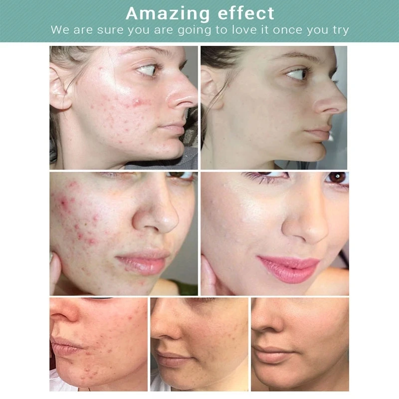 

100g LANBENA Acne Treatment Cleansing Mask Clean Up Pore Garbage Repair Acne Skin Care Shrink Pores Whitening Oil Control