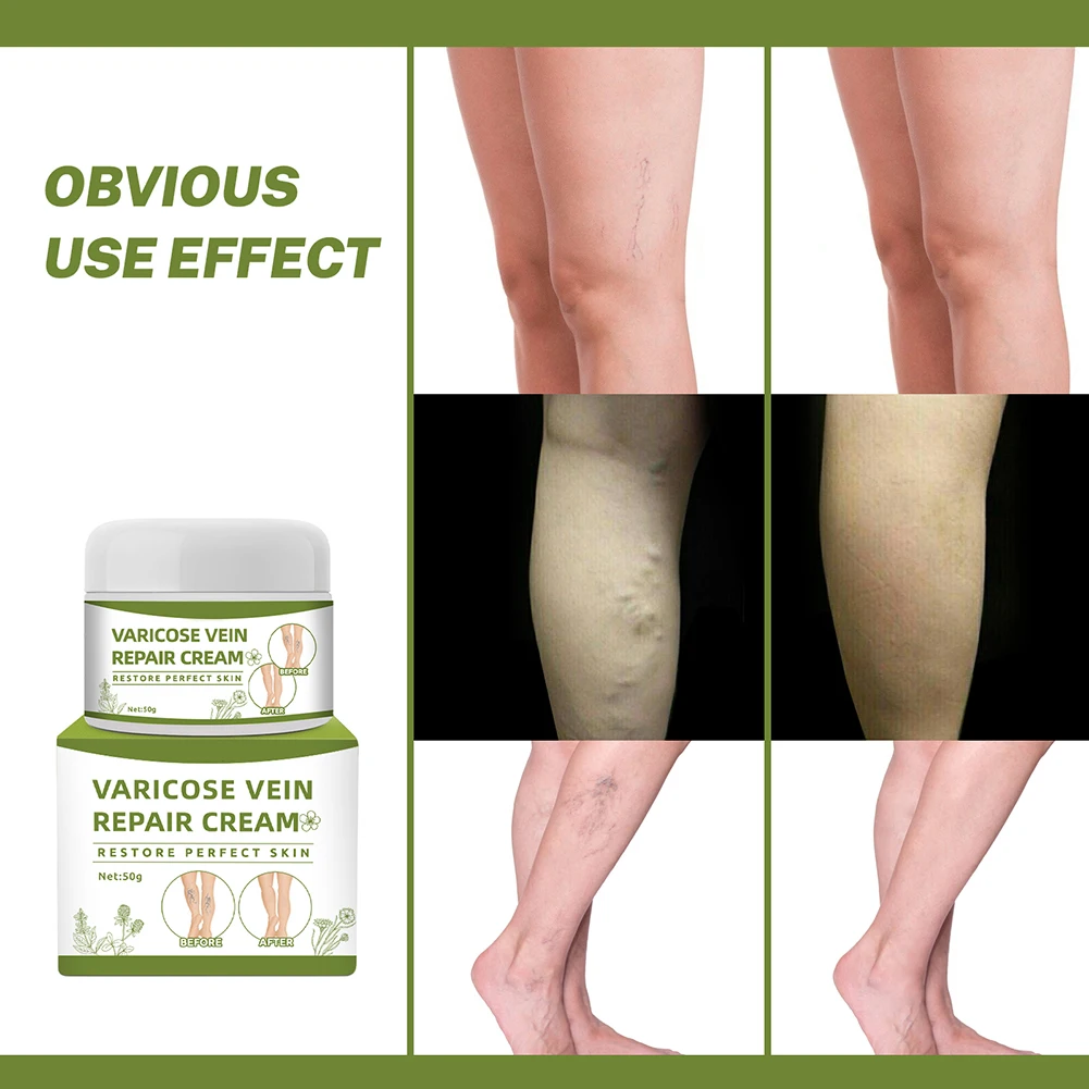 Антибактериальный крем от варикозного расширения вен 50 г |