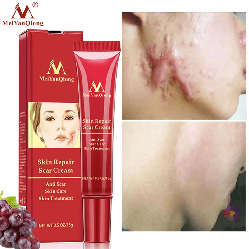 

Scar Removal Face Cream Acne Scars Gel Stretch Marks Surgical Scar Burn For Body Pigmentation Corrector Acne Spots Repair Care