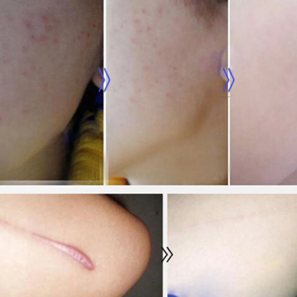 Гель для удаления шрамов от келоидов ожогов спортивных травм акне 30 г