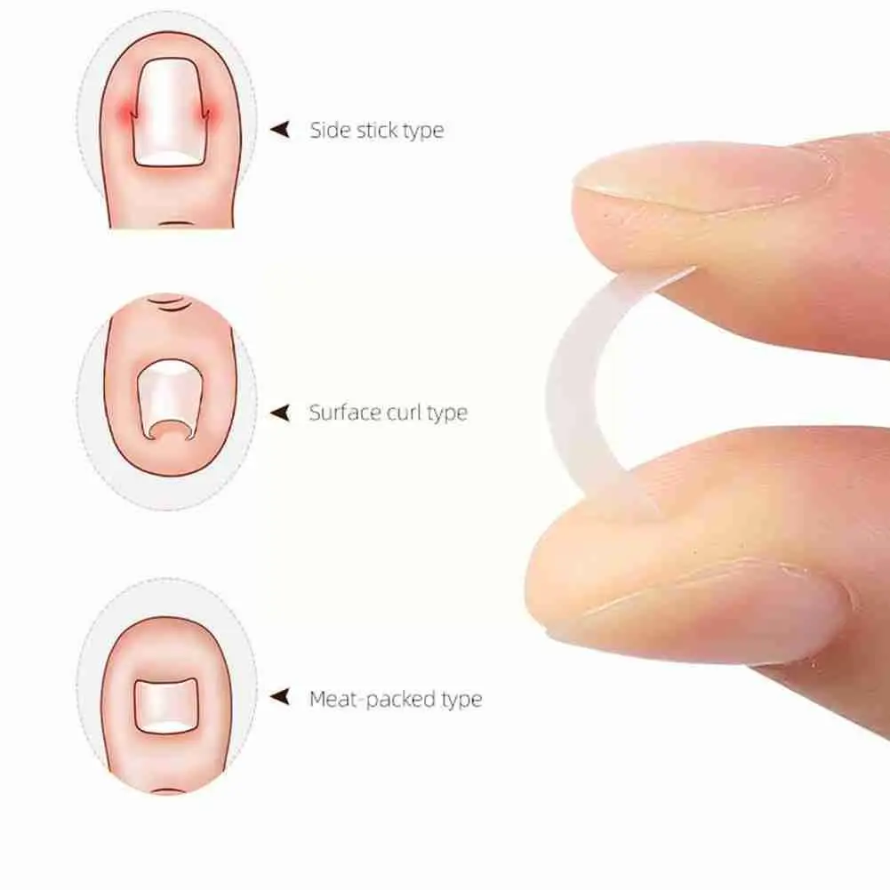 

New Pedicure Tool Ingrown Nails Toenail Correction Toe Treatment Patch Nail Elastic Straightening Care Brace Clip Sticker F F7B1