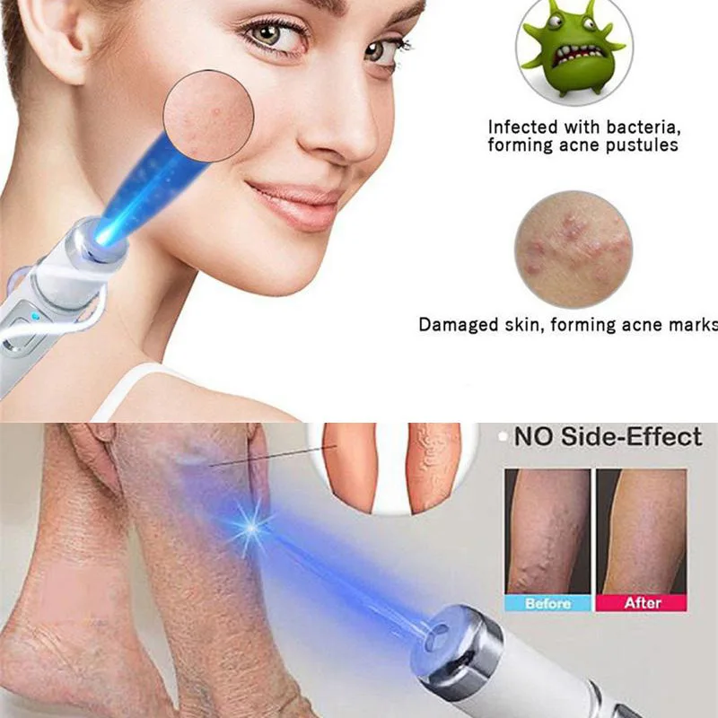 

Heath Blue Light Therapy Varicose Veins Treatment Laser Pen Soft Scar Wrinkle Removal Treatment Acne Laser Pen Massage Relax