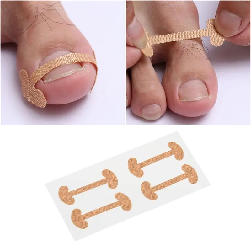 20pcs Toenail Stickers Toenail Correction Tool Ingrown Toe Nail Treatment Toenail Straightening Sticker for Home Shops