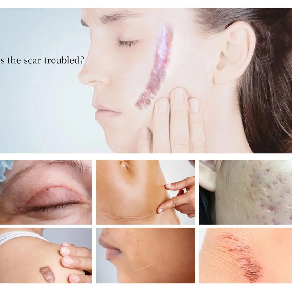 20 г крем для ремонта шрамов от акне шрамы ожоги проникнут глубокими смягченными