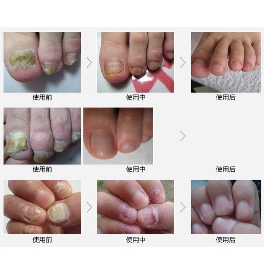 10 мл * 2 убивает бактерии уход за ногтями Лечение грибка масло онихомикоз