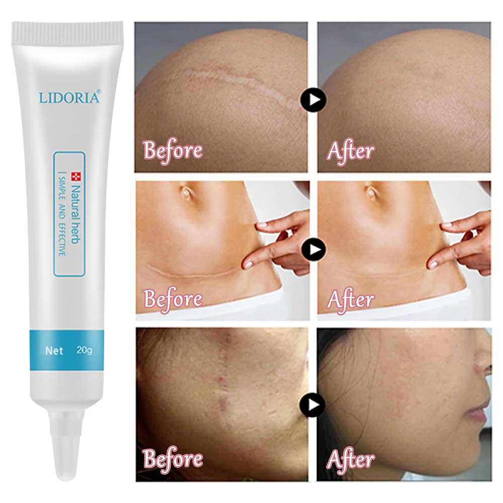 Scar Stretch Marks Remover Cream Skin Repair Cream Acne Treatment Whitening