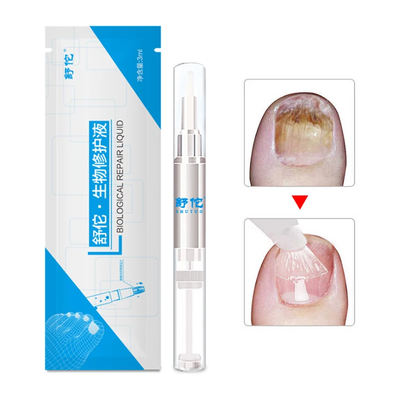 3ml Nail Fungus Treatment Liquid Anti Fungal Finger Toe Nails Care NShopping